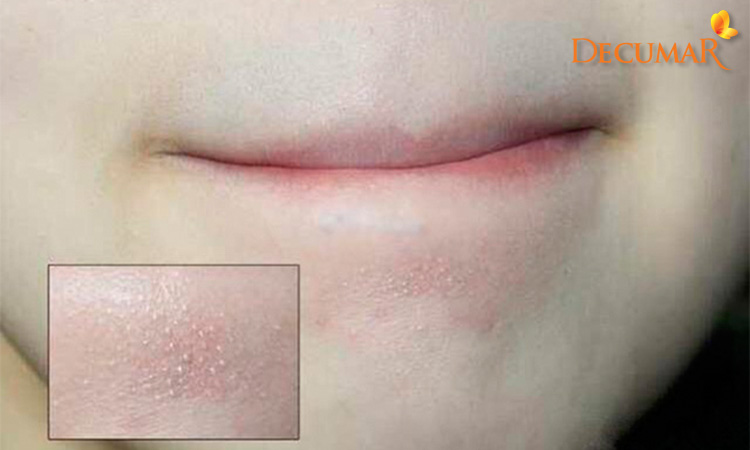 Mụn cám quanh miệng hình thành do rối loạn tuyến dầu nhờn trên da