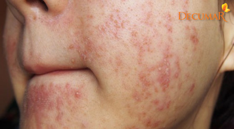 Có rất nhiều nguyên nhân dẫn tới tình trạng mụn viêm lan rộng ở trên da của bạn