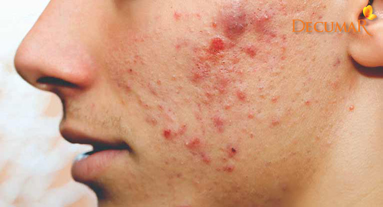 Mụn viêm đỏ là một loại mụn viêm khá nặng, ảnh hưởng trực tiếp tới làn da bạn