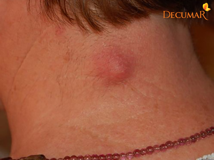 Mụn viêm dưới da hình thành rất có thể đã ăn sâu và các tế bào da của bạn