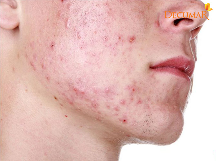 Mụn viêm chân lông ở da mặt có thể đến từ rất nhiều các nguyên nhân khác nhau