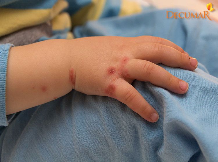 Muỗi đốt là một nguyên nhân gây ra các nốt thâm ở trẻ em rất phổ biến