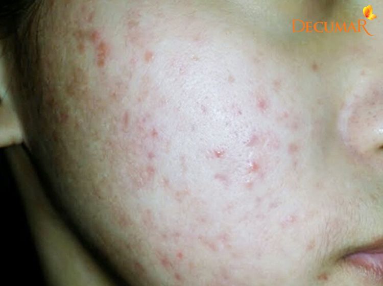 Da mặt bị mụn viêm – Nguyên nhân và cách điều trị triệt để