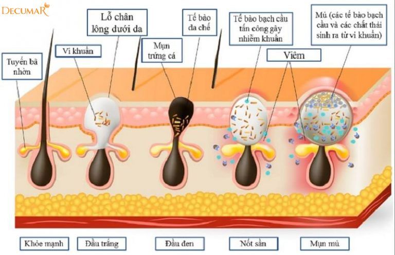 decumar nguyên nhân gây mụn