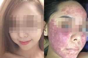 Kiều nữ Hà Nội hỏng da sau khi bôi kem trị mụn mua trên mạng