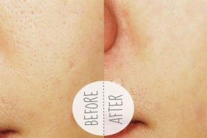 Tàn phai nhan sắc do trị mụn bằng mỹ phẩm chứa corticoid