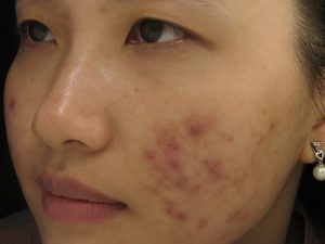 5 cách trị thâm mụn bằng nguyên liệu tự nhiên đơn giản, hiệu quả