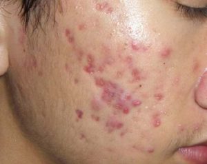 3 cách trị sẹo sau mụn đảm bảo hiệu quả chưa từng thấy