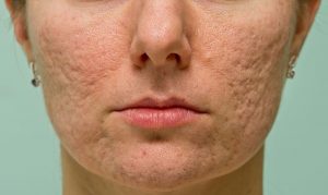 Biện pháp trị sẹo rỗ từ dân gian có thực sự hiệu quả?
