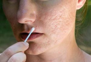 Những lưu ý quan trọng khi trị sẹo rỗ trên mặt