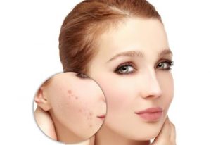 Hướng dẫn cách trị sẹo rỗ bằng mật ong cho hiệu quả như mong đợi