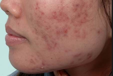 Làm thế nào để trị sẹo và mụn cho da tổn thương?