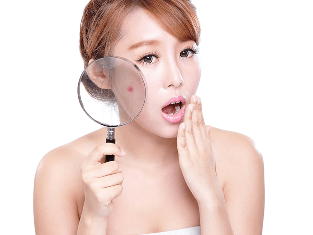 Trị sẹo và mụn siêu tốc từ thiên nhiên đảm bảo cho hiệu quả