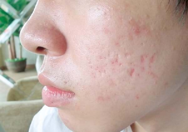 Cách trị sẹo và thâm mụn bằng chanh và mật ong cho hiệu quả bất ngờ