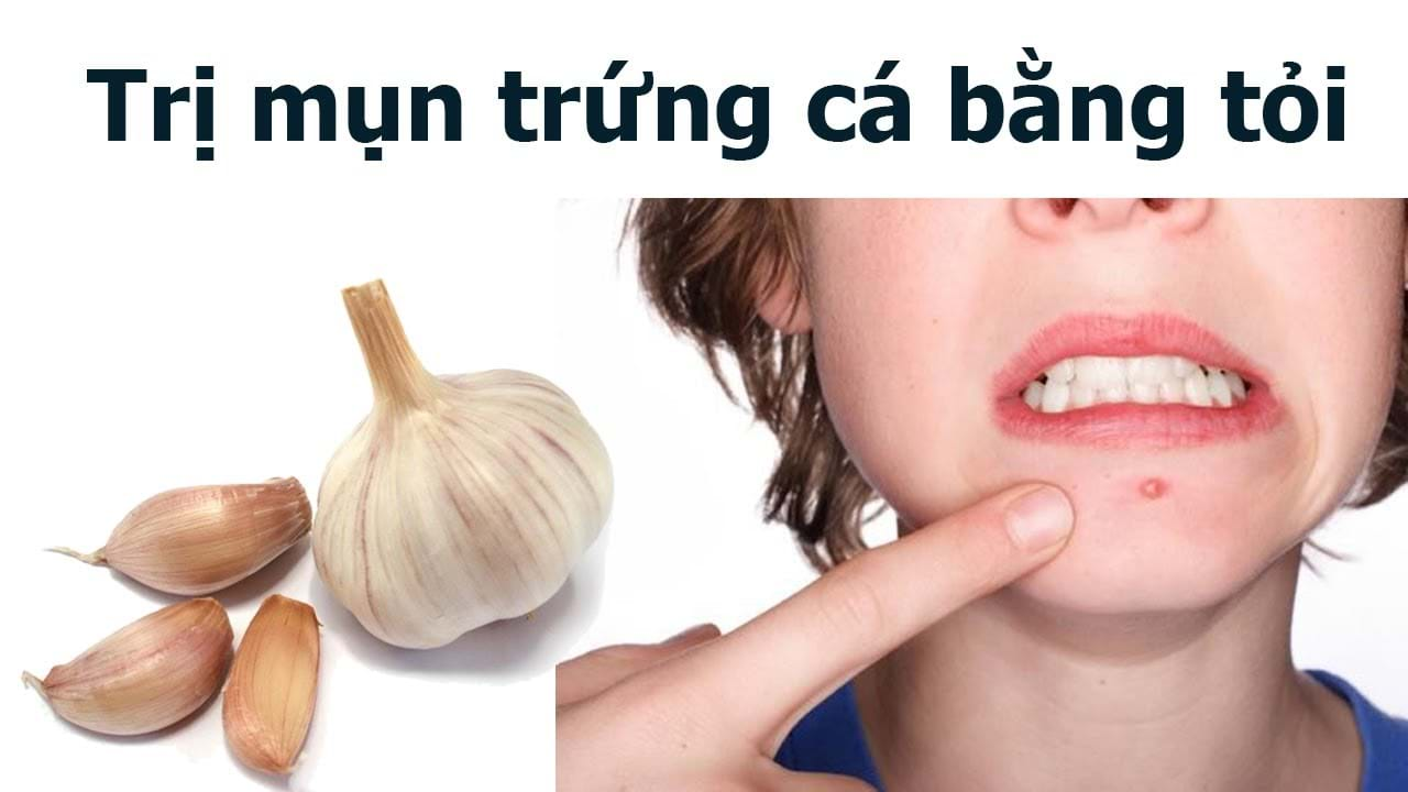 Dùng tỏi tươi trị mụn bọc, bạn đã thử chưa?