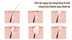 Những dấu hiệu nhìn là biết ngay da bạn đang bị mụn ẩn