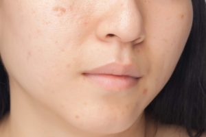 Bạn đang băn khoăn không biết gel trị thâm mụn nào tốt?