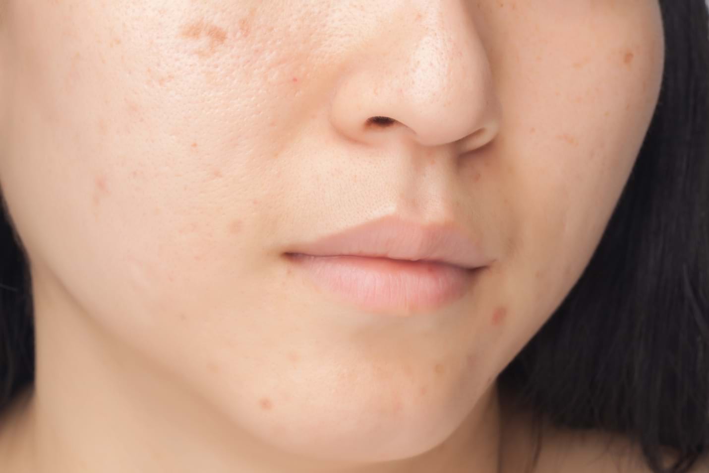 Bạn đang băn khoăn không biết gel trị thâm mụn nào tốt?