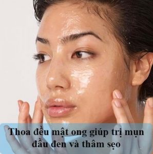 Trị mụn đầu đen hiệu quả tại nhà với 5 phương pháp đơn giản.