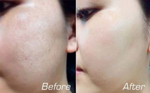 Bí quyết trị sẹo rỗ với 5 phương pháp đơn giản tại nhà