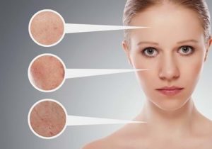 Mách chị em cách trị mụn cám tại nhà với 4 cách đơn giản