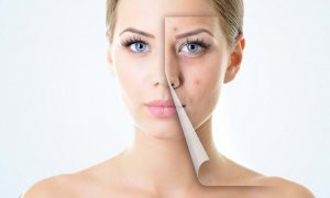 Thâm mụn đến mấy cũng bị đánh bay với 5 cách trị thâm này
