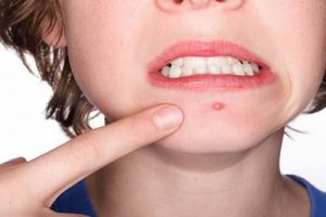 Mách chị em 4 cách trị mụn bọc cấp tốc hiệu quả ngay tại nhà
