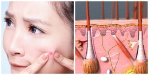 Mụn trứng cá ở tuổi teen và những điều cần biết!