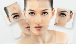 Trị mụn thâm cần hiểu rõ nguyên nhân để điều trị tận gốc
