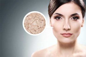 Bí quyết trị mụn trứng cá triệt để dành riêng cho các nàng da khô