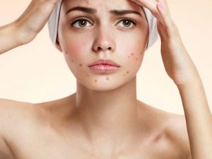 Cách chọn kem trị mụn trứng cá hiệu quả nhất, bạn đã biết?