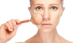 4 lưu ý nhất định phải biết nếu muốn trị mụn triệt để