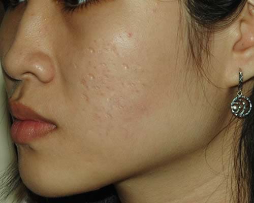 An toàn, hết sẹo ngay tại nhà với 5 phương pháp trị sẹo từ thiên nhiên