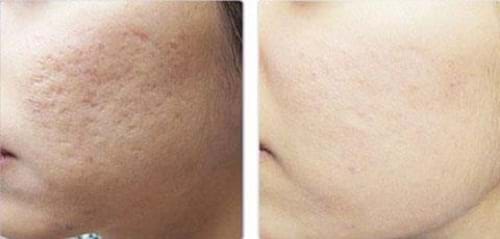 Phương pháp điều trị sẹo rỗ hiệu quả tại nhà từ nguyên liệu tự nhiên ( Phần 1)
