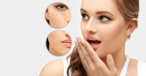 Trị mụn thâm với các nguyên liệu từ thiên nhiên ( Phần 1)
