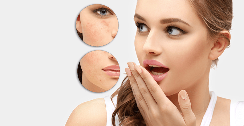 Trị mụn thâm với các nguyên liệu từ thiên nhiên ( Phần 1)
