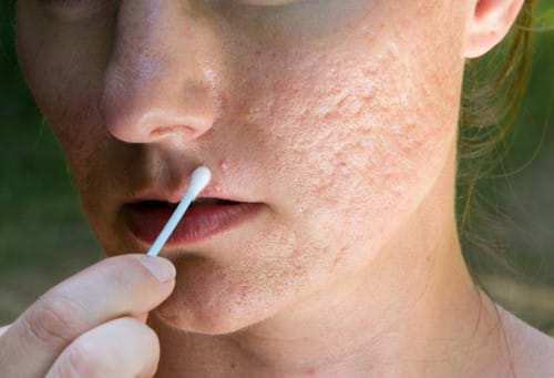 Trị sẹo rỗ từ mụn đầu đen và cách ngăn ngừa