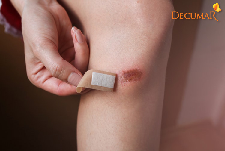 Vết trầy xước da ở đầu gối nhẹ