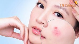 Nguyên nhân gây mụn bọc ở mặt và hướng xử lý