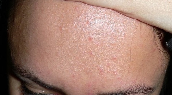 Mụn ẩn trên trán
