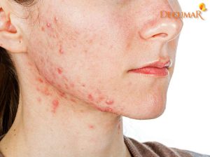 Khám phá 7 cách trị mụn bọc sưng đỏ tại nhà hiệu quả bất ngờ