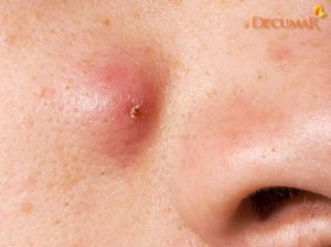 Bỏ túi 11+ cách trị mụn bọc tại nhà đơn giản mà dễ thực hiện