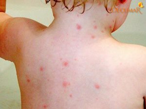 Nóng trong người nổi mẩn đỏ do đâu? Điều trị như thế nào?