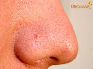 Top 10 cách trị mụn cám ở trên mặt có thể làm tại nhà