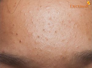 Mách bạn 5 cách trị mụn cám cho nam giới đơn giản, dễ làm