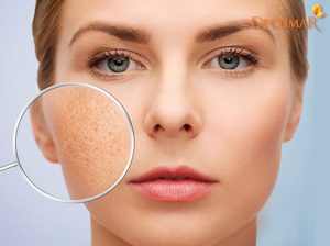 Hướng dẫn cách ngừa mụn cám tại nhà hiệu quả