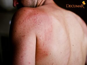 Da mỏng dễ bị trầy xước phải làm sao?