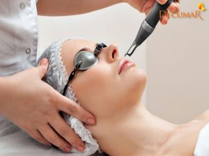Có nên điều trị sẹo thâm bằng laser không?