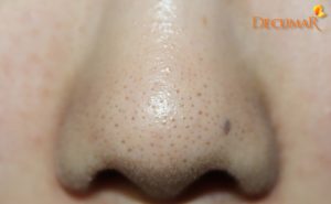11 cách trị mụn cám ở mũi đơn giản mà vô cùng hiệu quả