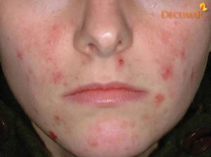 Tổng hợp những cách trị sẹo thâm đỏ đơn giản mà hiệu quả